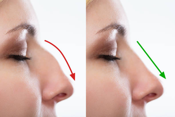 Woman's Nose Before And After Plastic Surgery With Red And Green Arrows istockphoto 1042651532 612x612 1